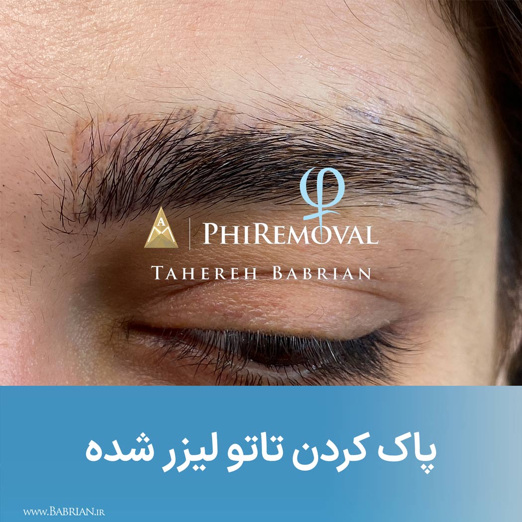 معجزه پاک کردن تاتو های تازه بلید شده